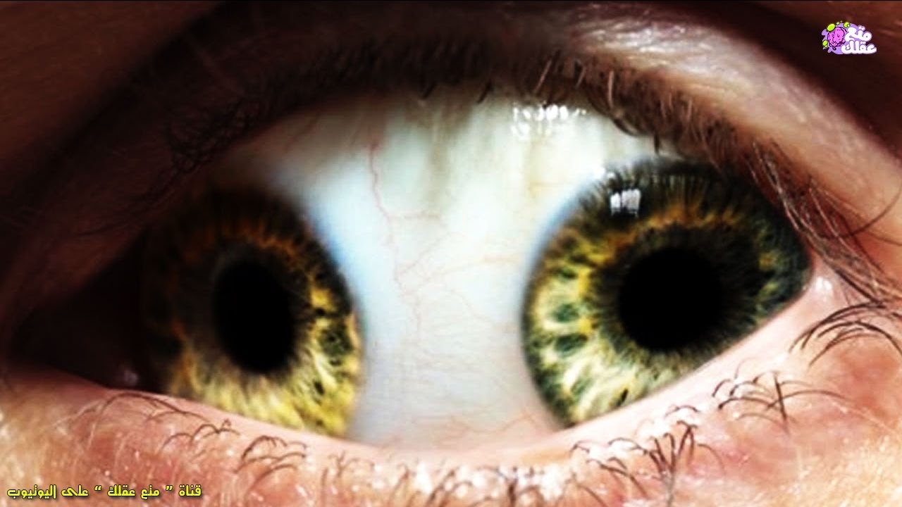 أغرب 10 حالات طبية نادرة عرفتها البشرية